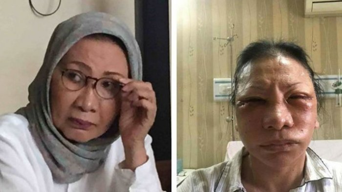 Foto wajah lebam dan bengkak Ratna Sarupaet sempat viral di media sosial. (Foto: Instagram)